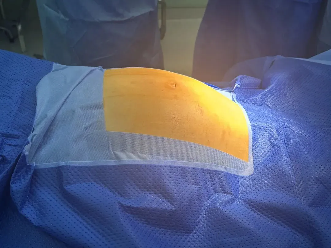 中考在即少女腹中竟藏篮球般肿瘤,医生团队精准研判,单孔微创精准为备考“抢”时间 第2张