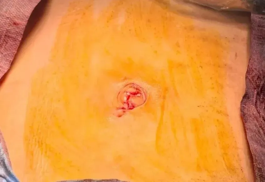 中考在即少女腹中竟藏篮球般肿瘤,医生团队精准研判,单孔微创精准为备考“抢”时间 第3张