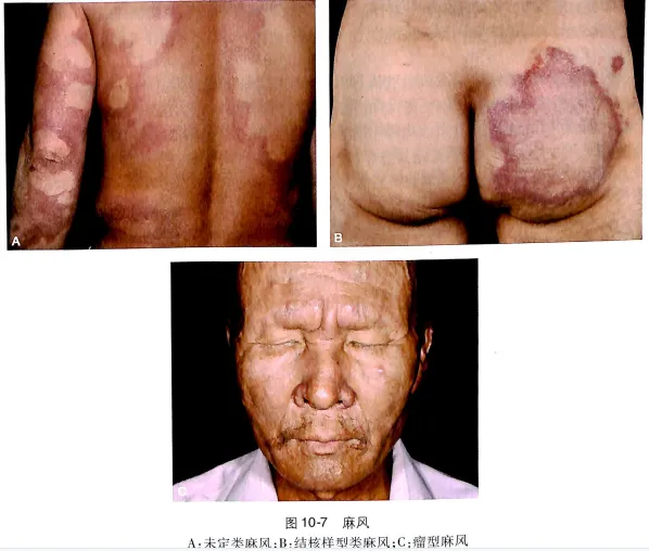 医学生必备:麻风应试精华(附真题) 第5张