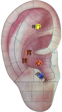 耳穴疗法 | 中考和高考前,会耳穴的你可以为考生做点什么?-第9张图片-四季读书网