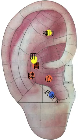 耳穴疗法 | 中考和高考前,会耳穴的你可以为考生做点什么?-第13张图片-四季读书网