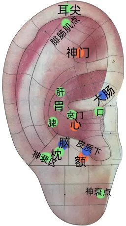 耳穴疗法 | 中考和高考前,会耳穴的你可以为考生做点什么?-第17张图片-四季读书网