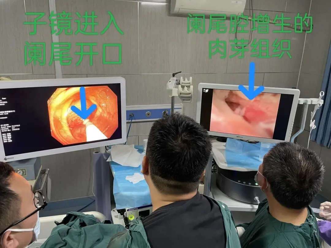 中考/高考在即,大名县人民医院开通阑尾炎ERAT治疗绿色通道-第11张图片-四季读书网 中考/高考在即,大名县人民医院开通阑尾炎ERAT治疗绿色通道-第11张图片-四季读书网