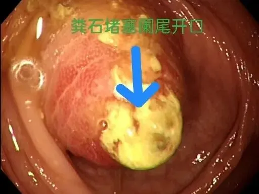 中考/高考在即,大名县人民医院开通阑尾炎ERAT治疗绿色通道-第12张图片-四季读书网 中考/高考在即,大名县人民医院开通阑尾炎ERAT治疗绿色通道-第12张图片-四季读书网