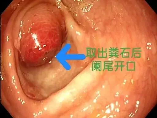 中考/高考在即,大名县人民医院开通阑尾炎ERAT治疗绿色通道-第13张图片-四季读书网 中考/高考在即,大名县人民医院开通阑尾炎ERAT治疗绿色通道-第13张图片-四季读书网