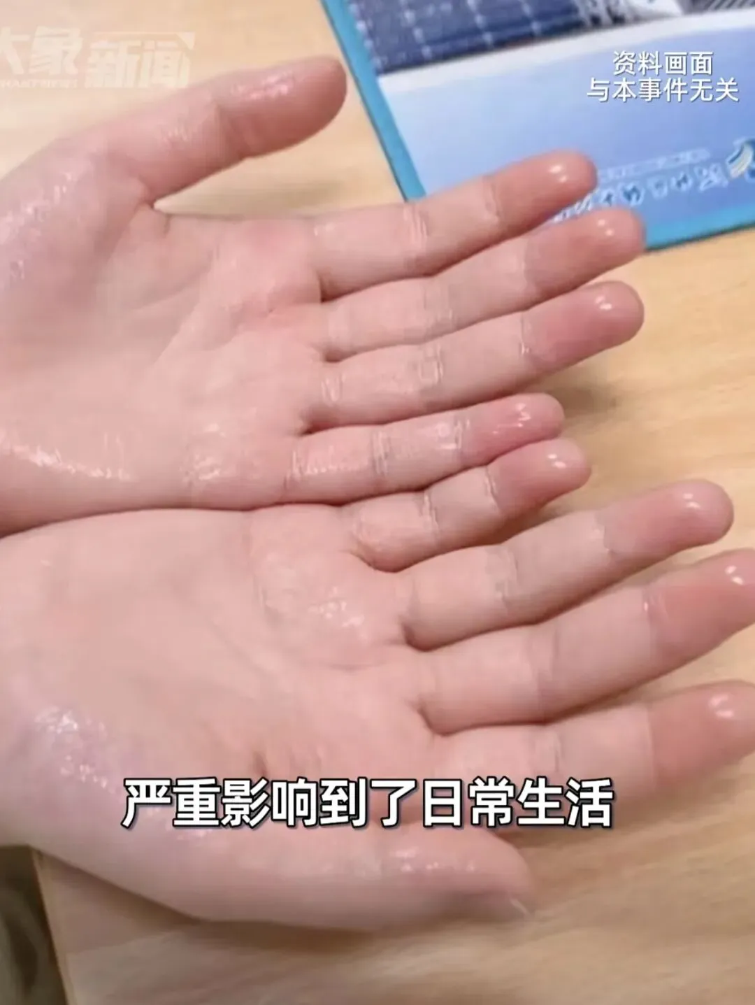 试卷被汗水浸湿、握笔不停打滑?别再误以为只是“紧张”!-第1张图片-四季读书网 试卷被汗水浸湿、握笔不停打滑?别再误以为只是“紧张”!-第1张图片-四季读书网