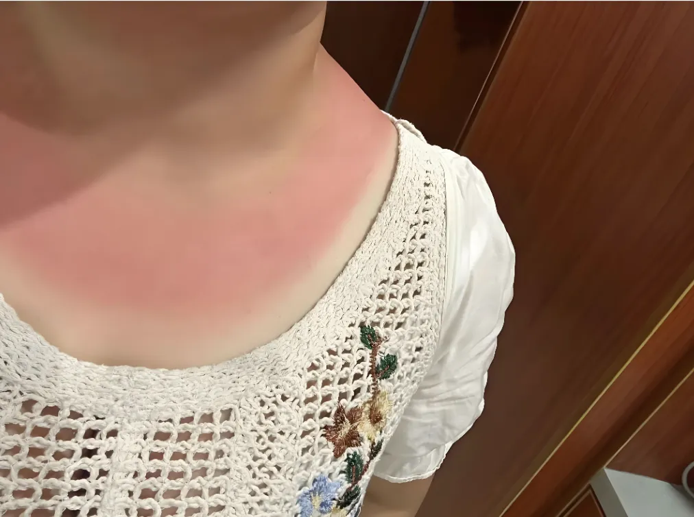 出门旅游惨遭晒伤?这份晒后完整保养攻略,快速褪红修护不反黑