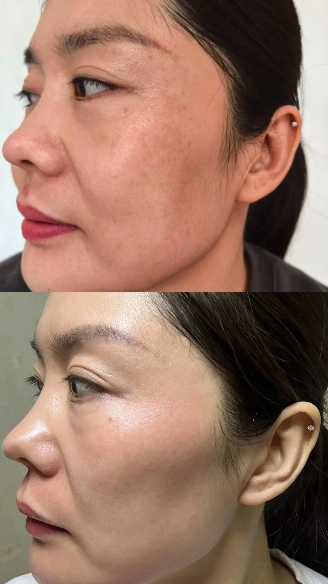 祛斑前后对比🌿