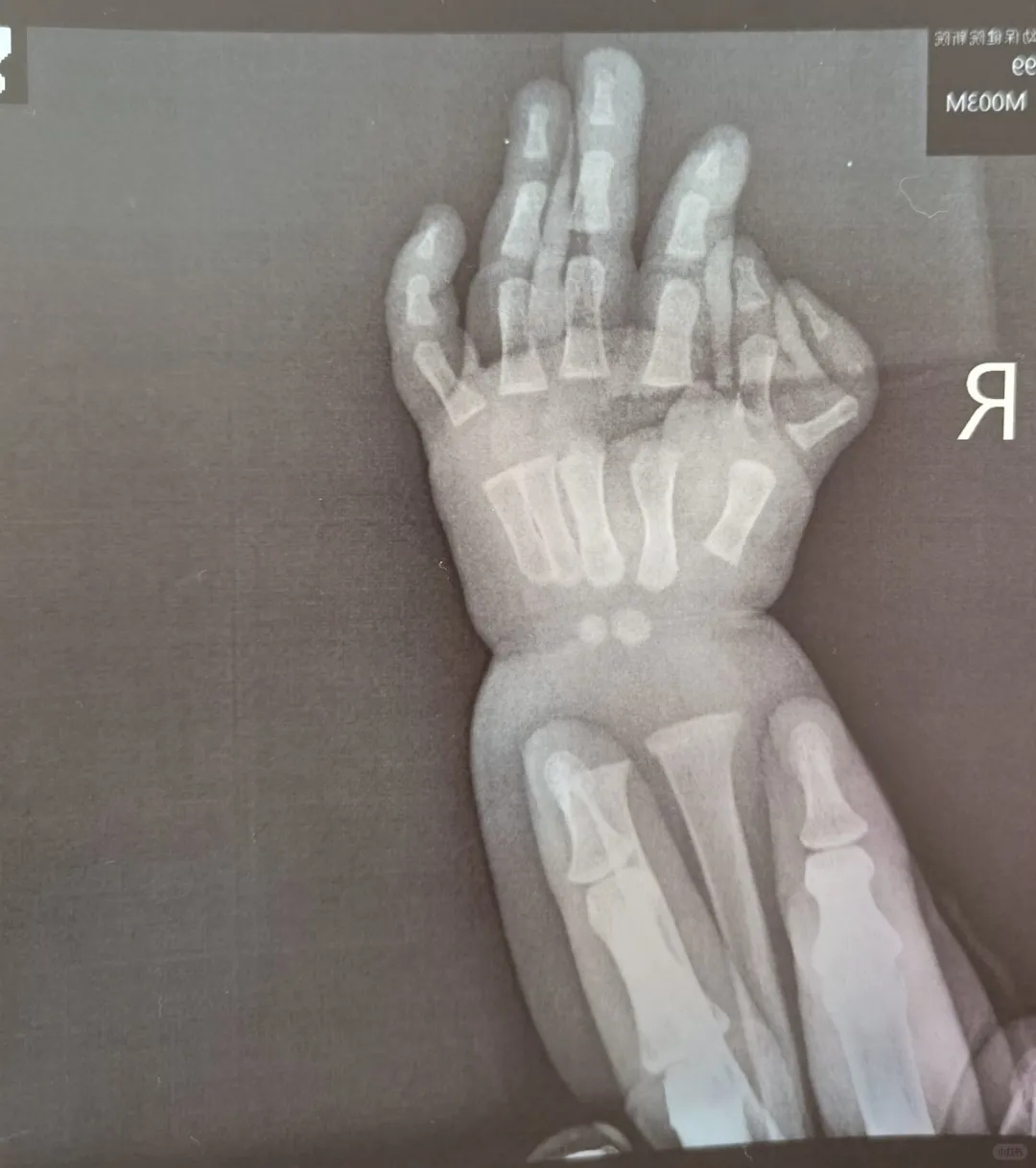 多指手术择医生篇