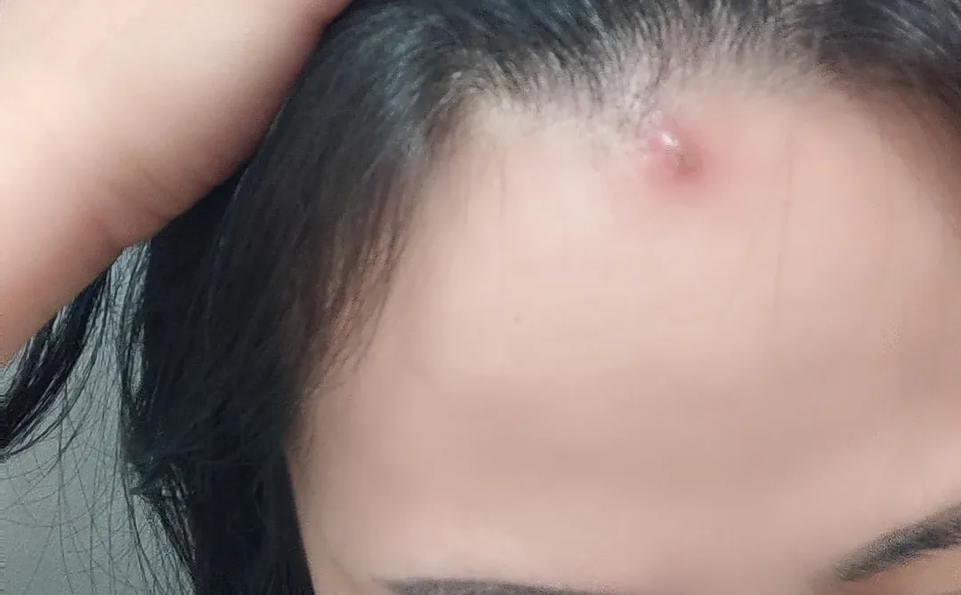 火疖子的至高点😭😭😭