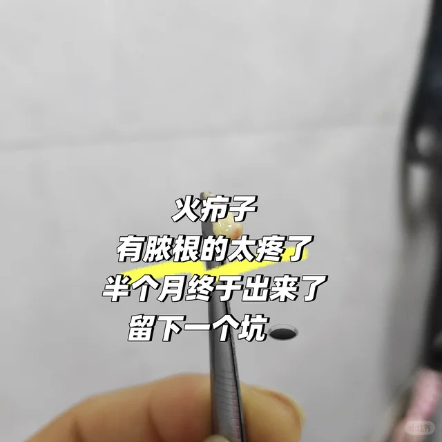 火疖子的至高点😭😭😭