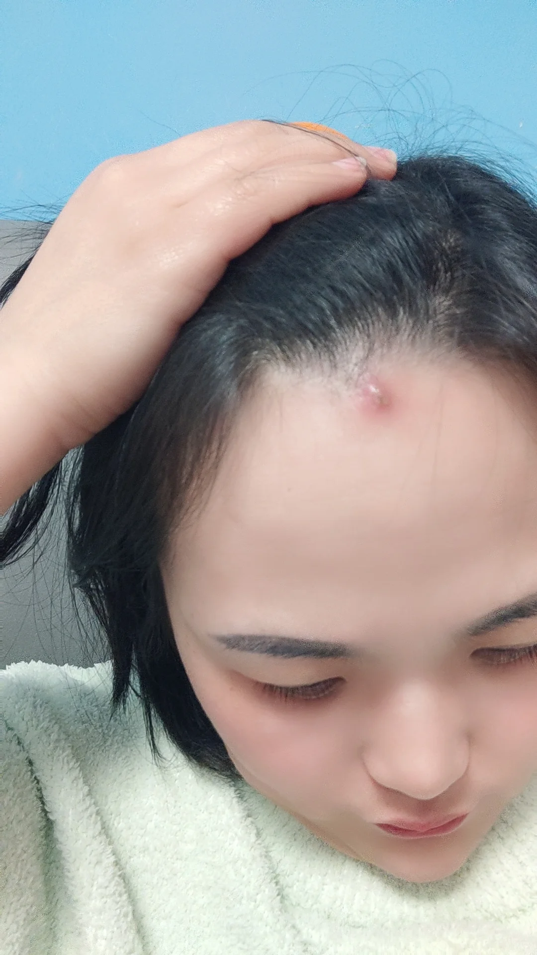 火疖子的至高点😭😭😭