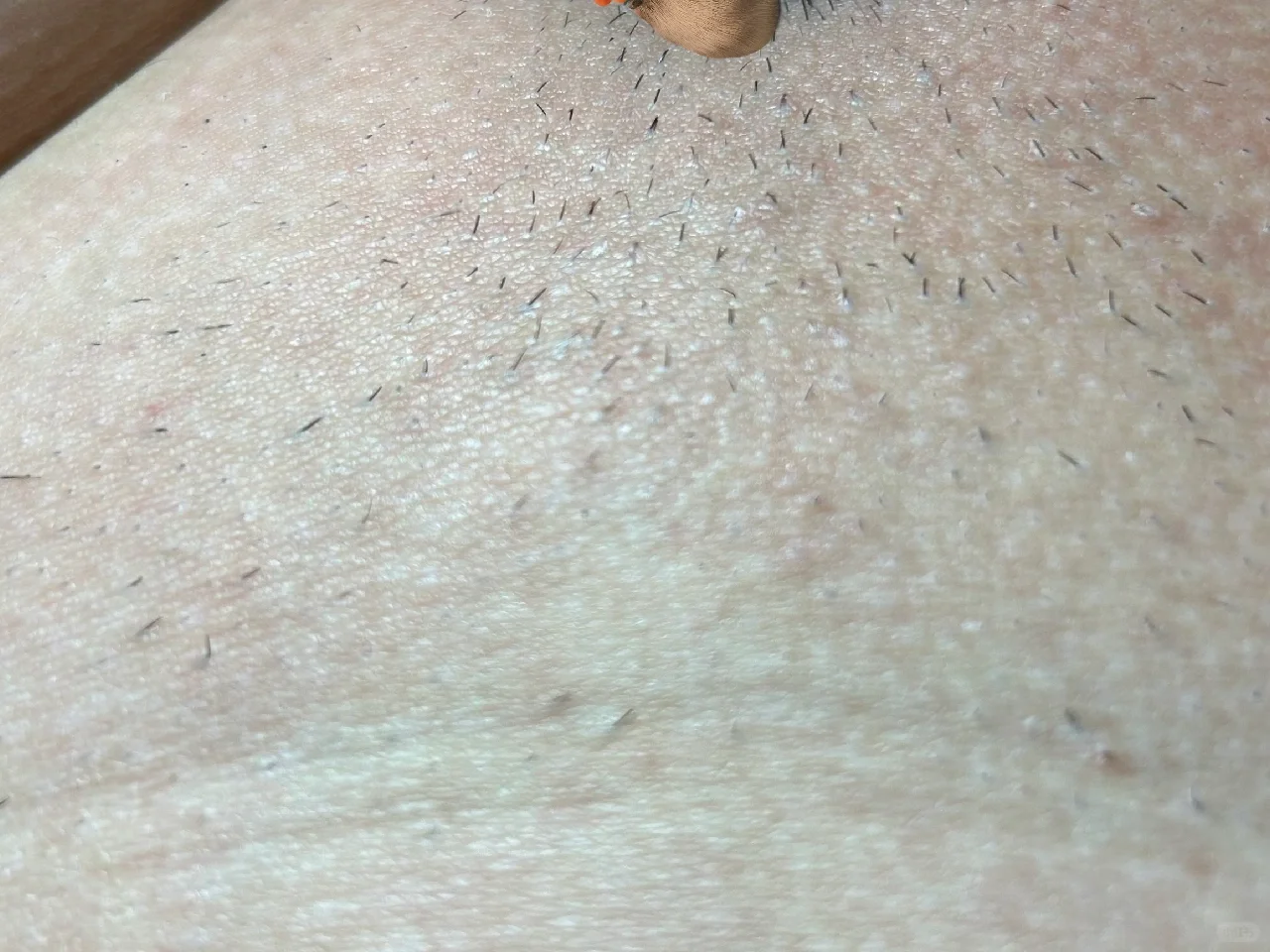 脱毛仪比基尼打卡 1️⃣7️⃣