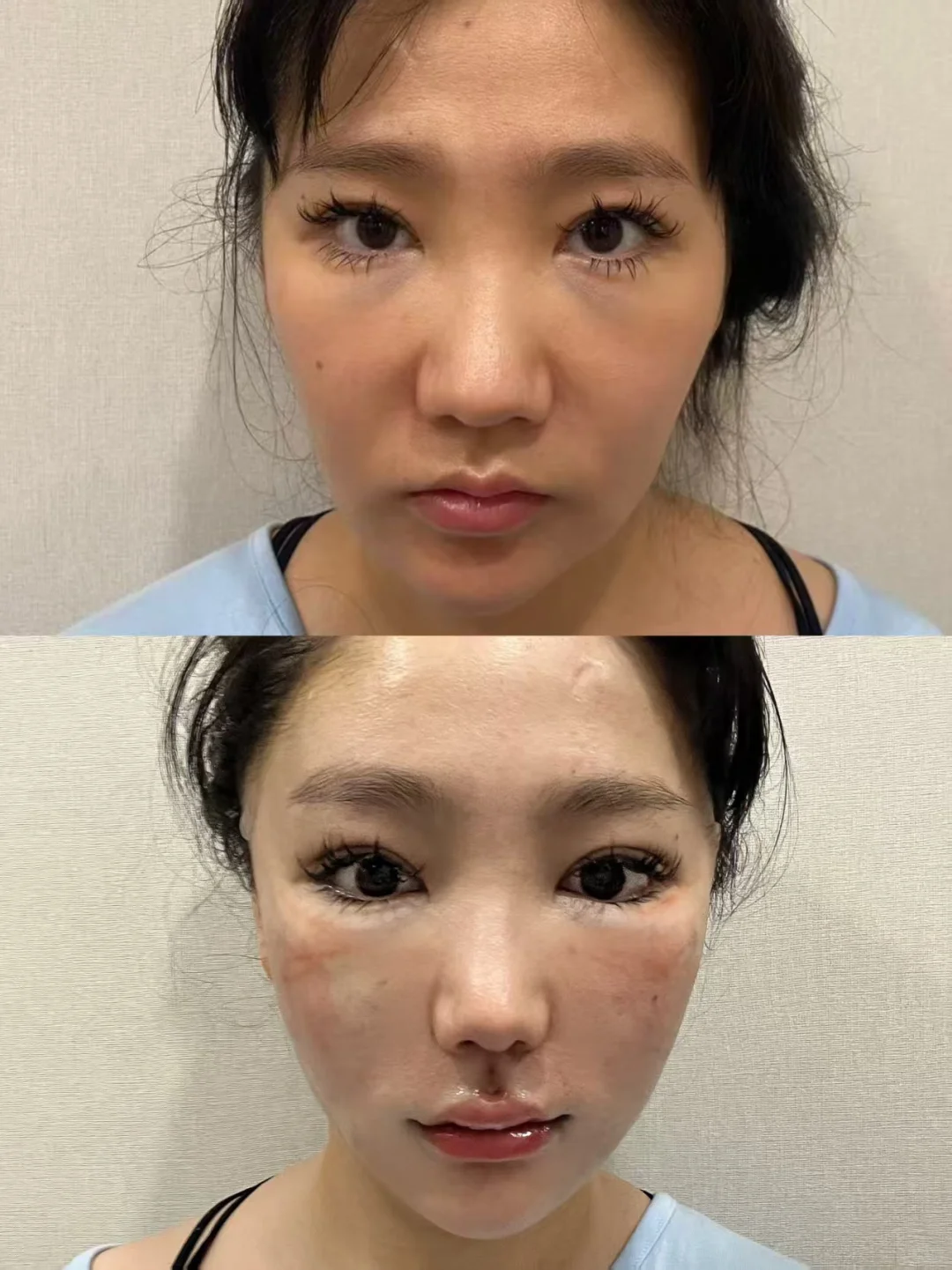 钻石网➕人中前后对比，2w真的不值吗？