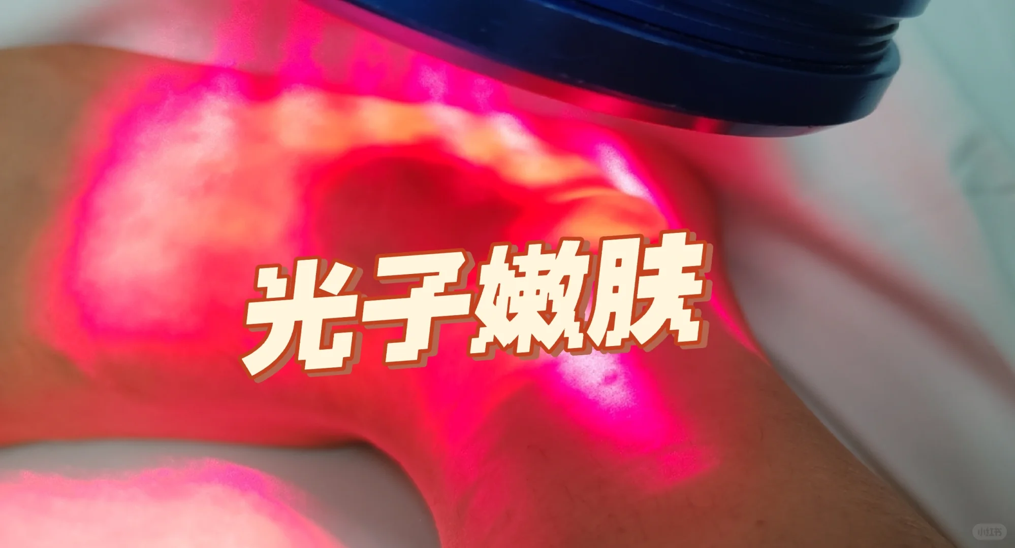 为了马拉松做上光子嫩肤和超声美足