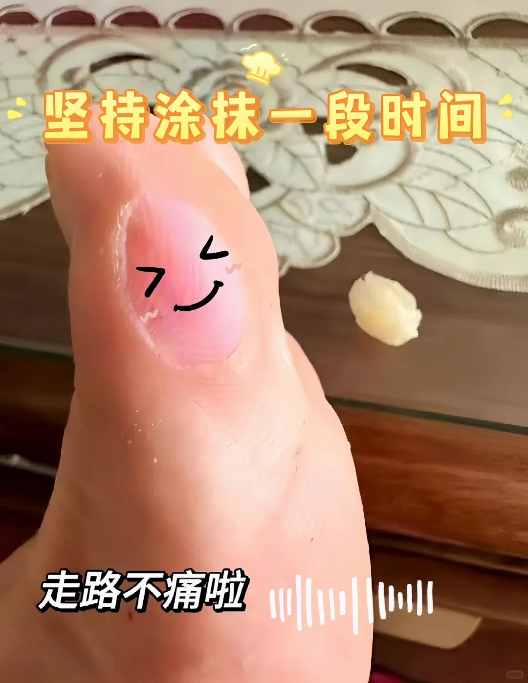 告别脚趾旁老茧 还你精致美脚