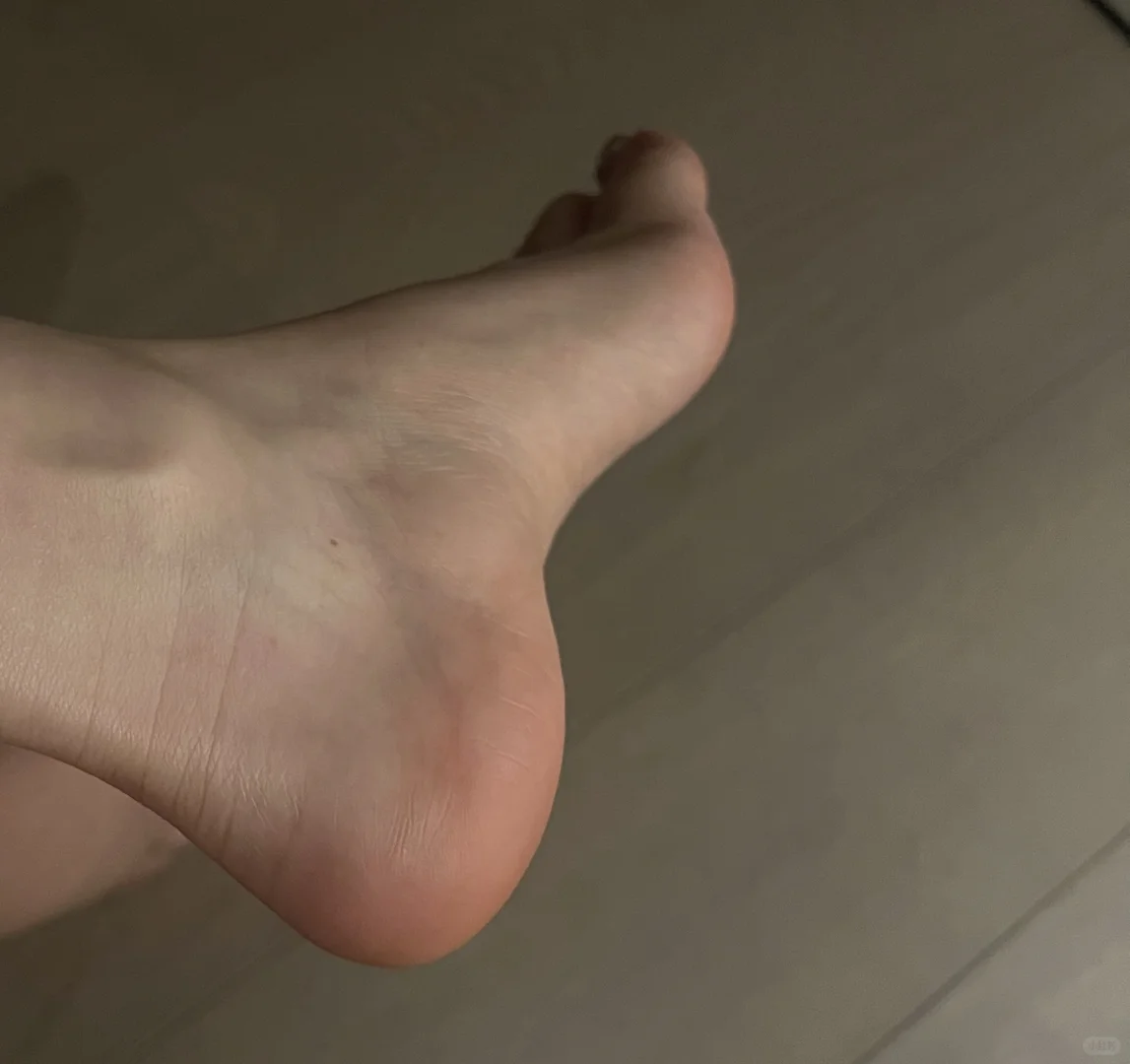 后脚跟开裂