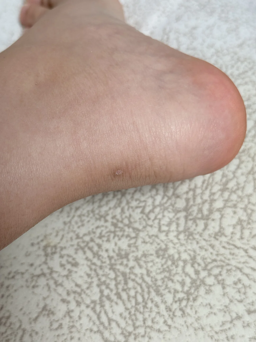 「脚后跟干裂救星!」穿凉鞋再也不尴尬了!