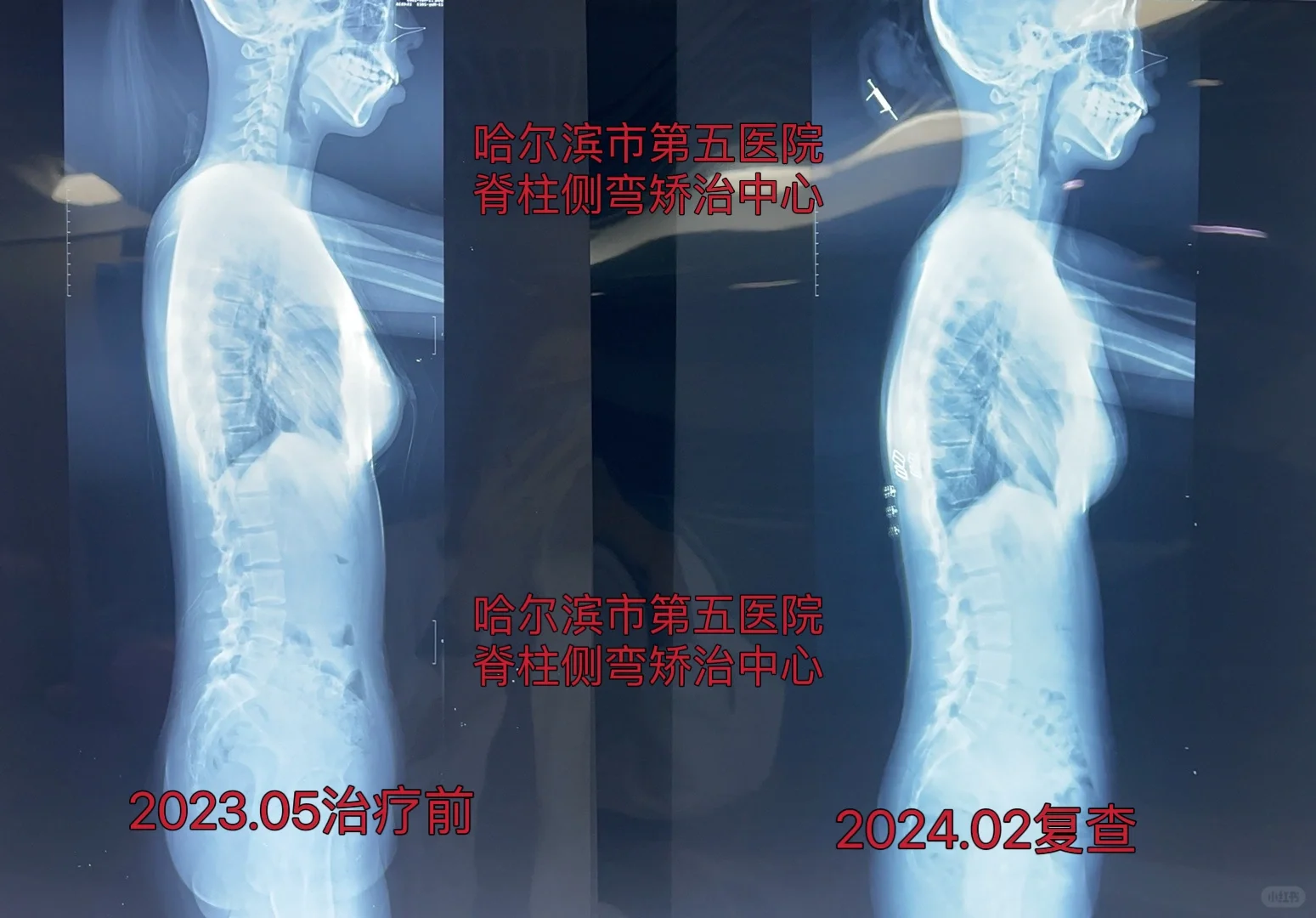 脊柱侧弯｜即将中考却一直坚持真的不容易