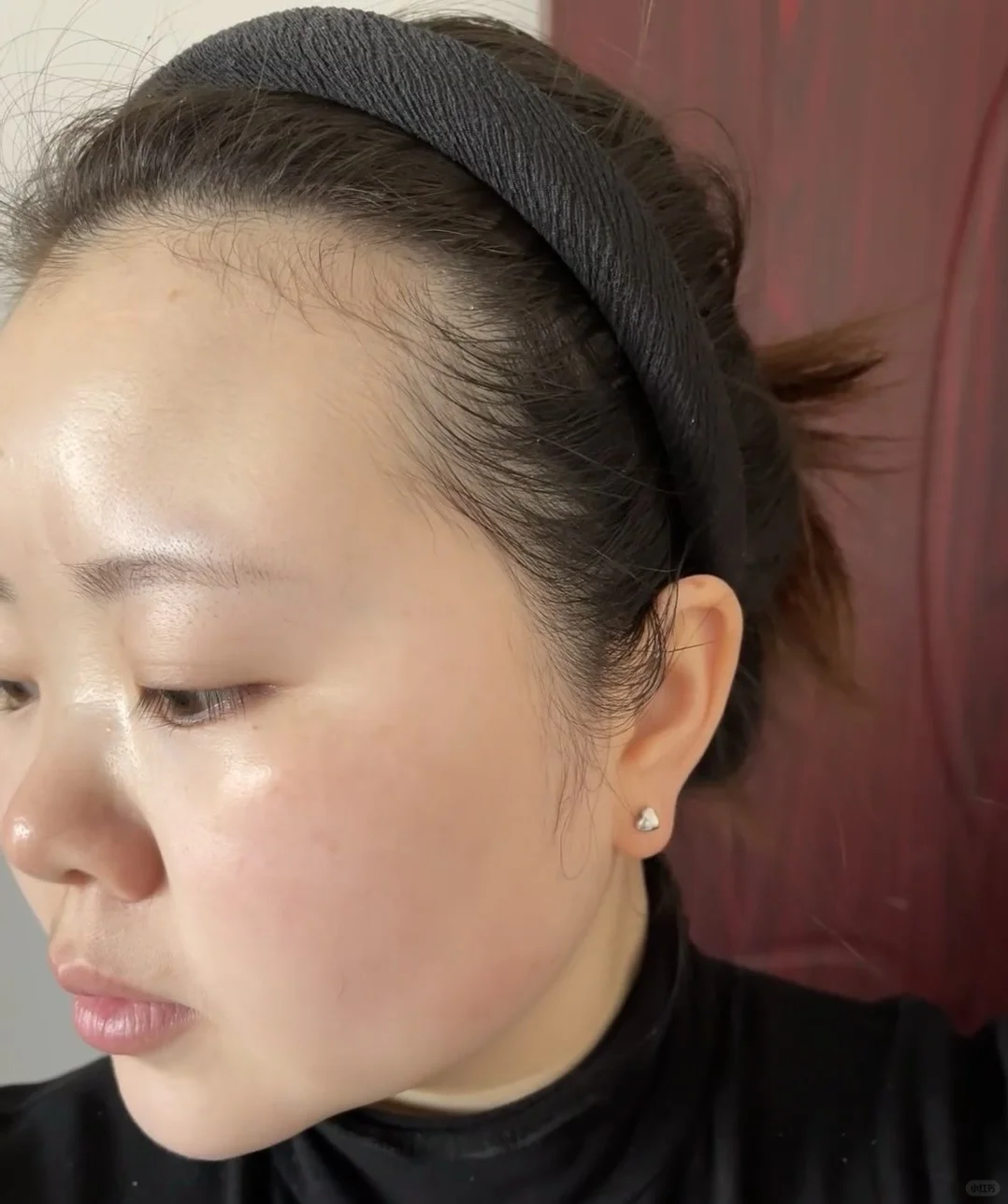 热玛吉做完半个月 直接看图吧