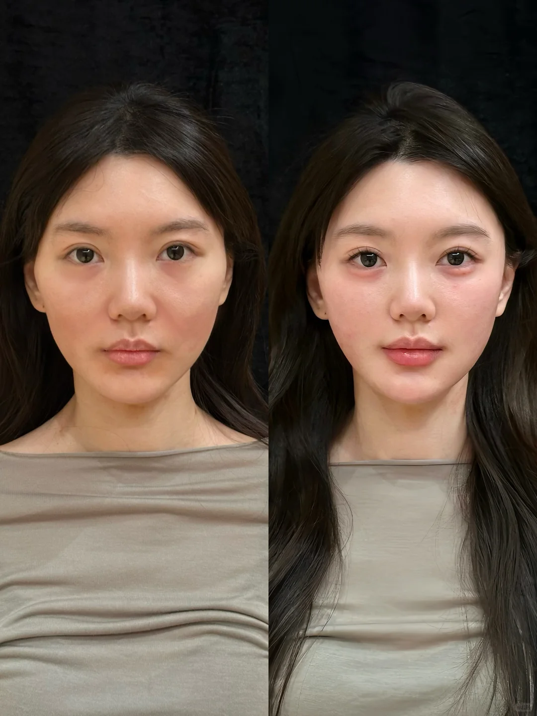 30岁全脸微调 美貌值已经next level