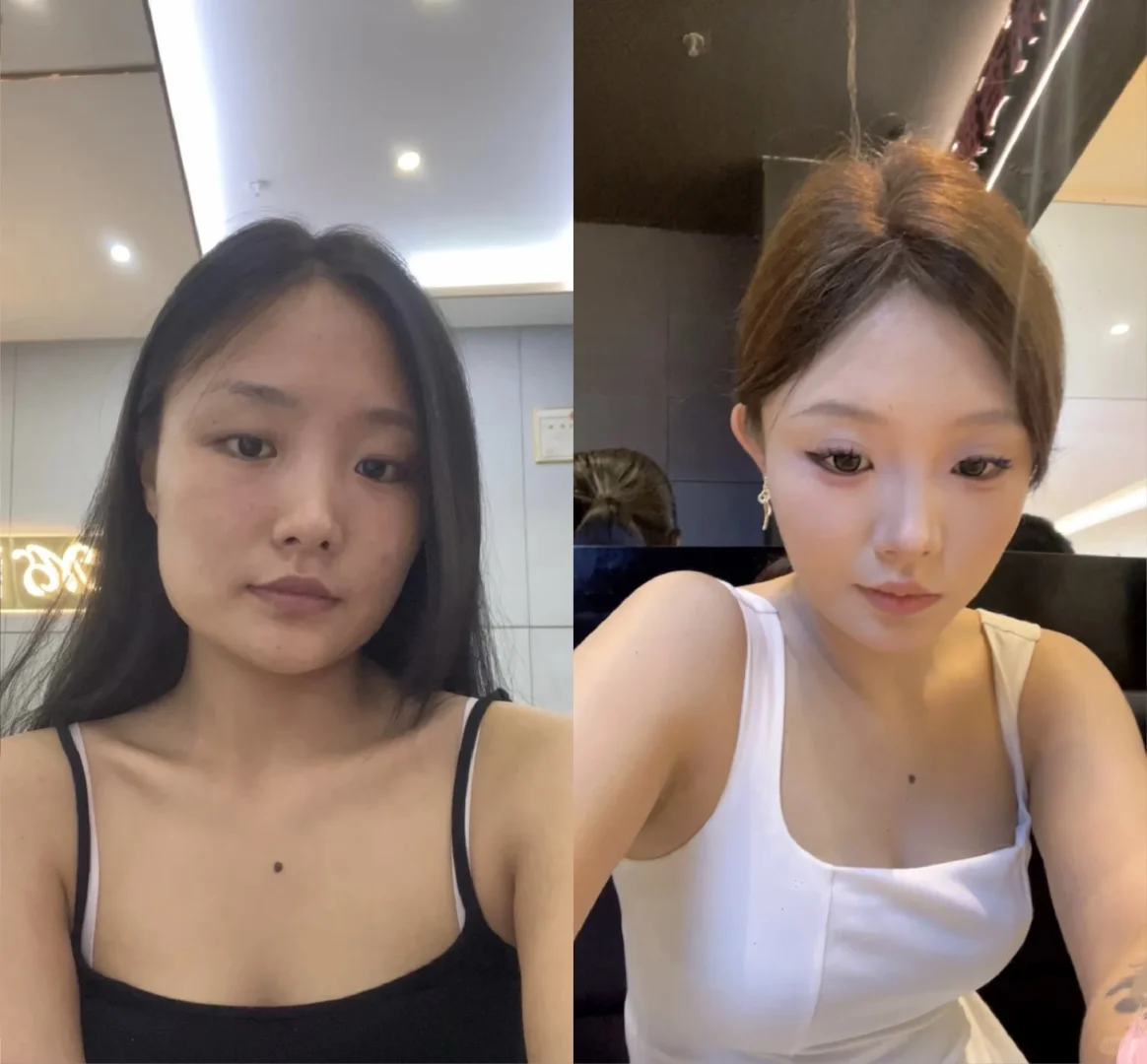 瘦脸针一个月了