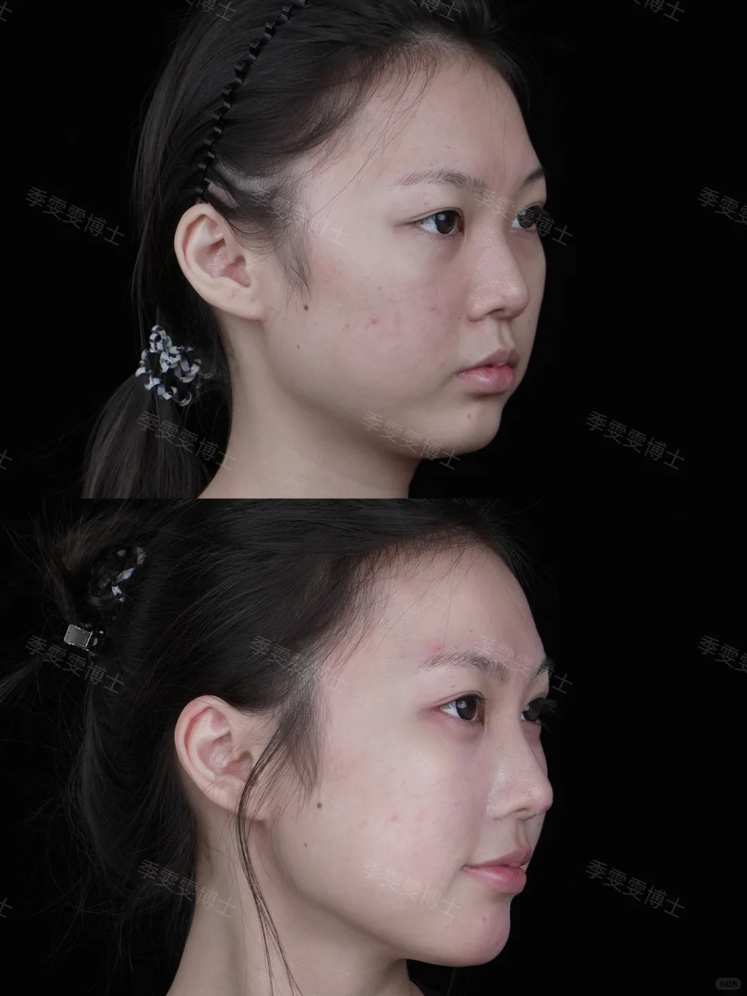 阔面方圆脸变紧致立体，原来是这个调整思路
