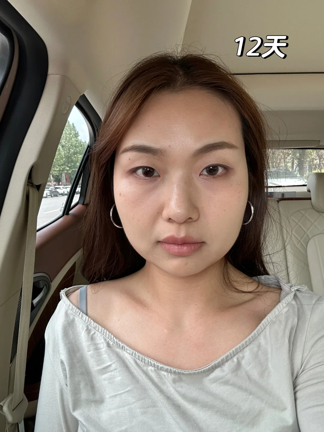 超声炮对肉肉脸真的有用