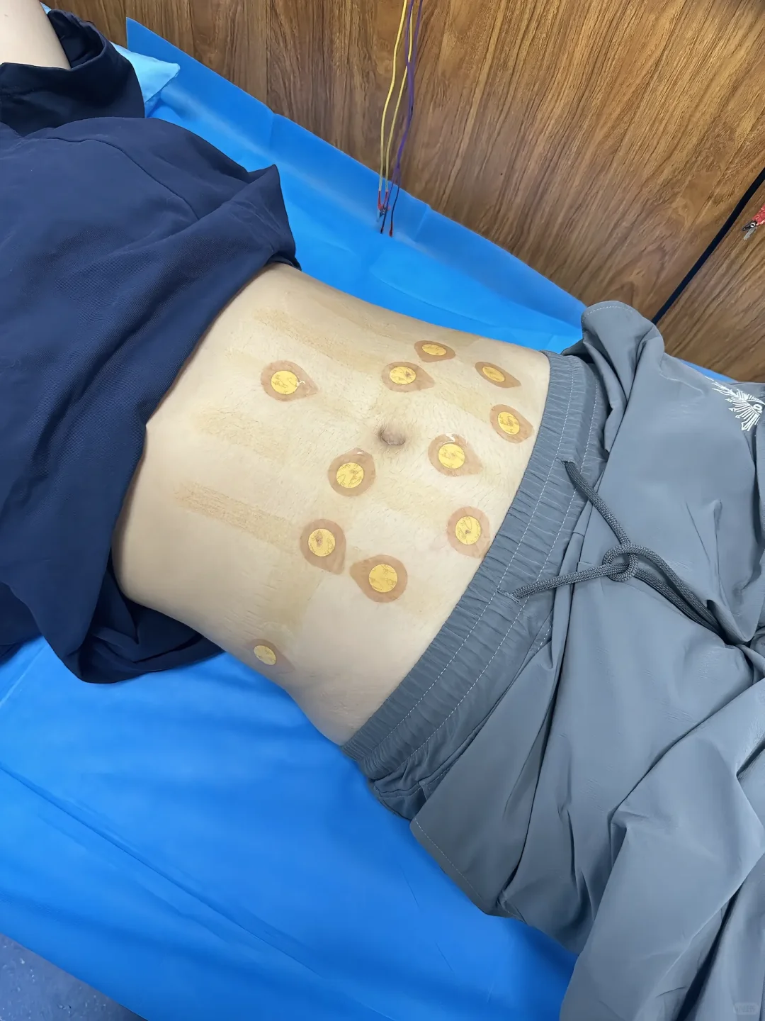 昆明|中医埋线减肥真的有用吗⁉️