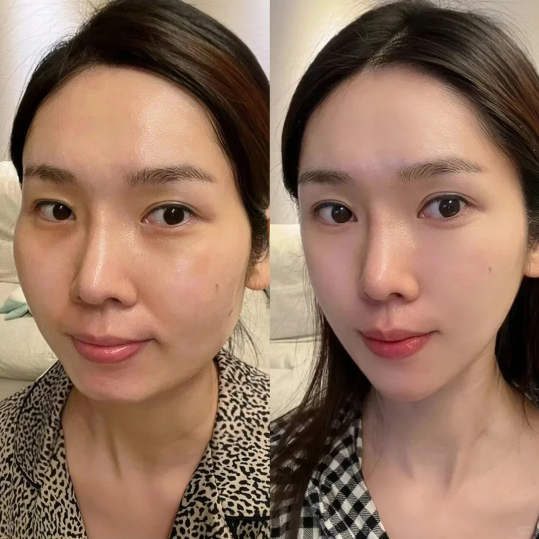 45岁 面部提升 上岸了吗#帮我看看