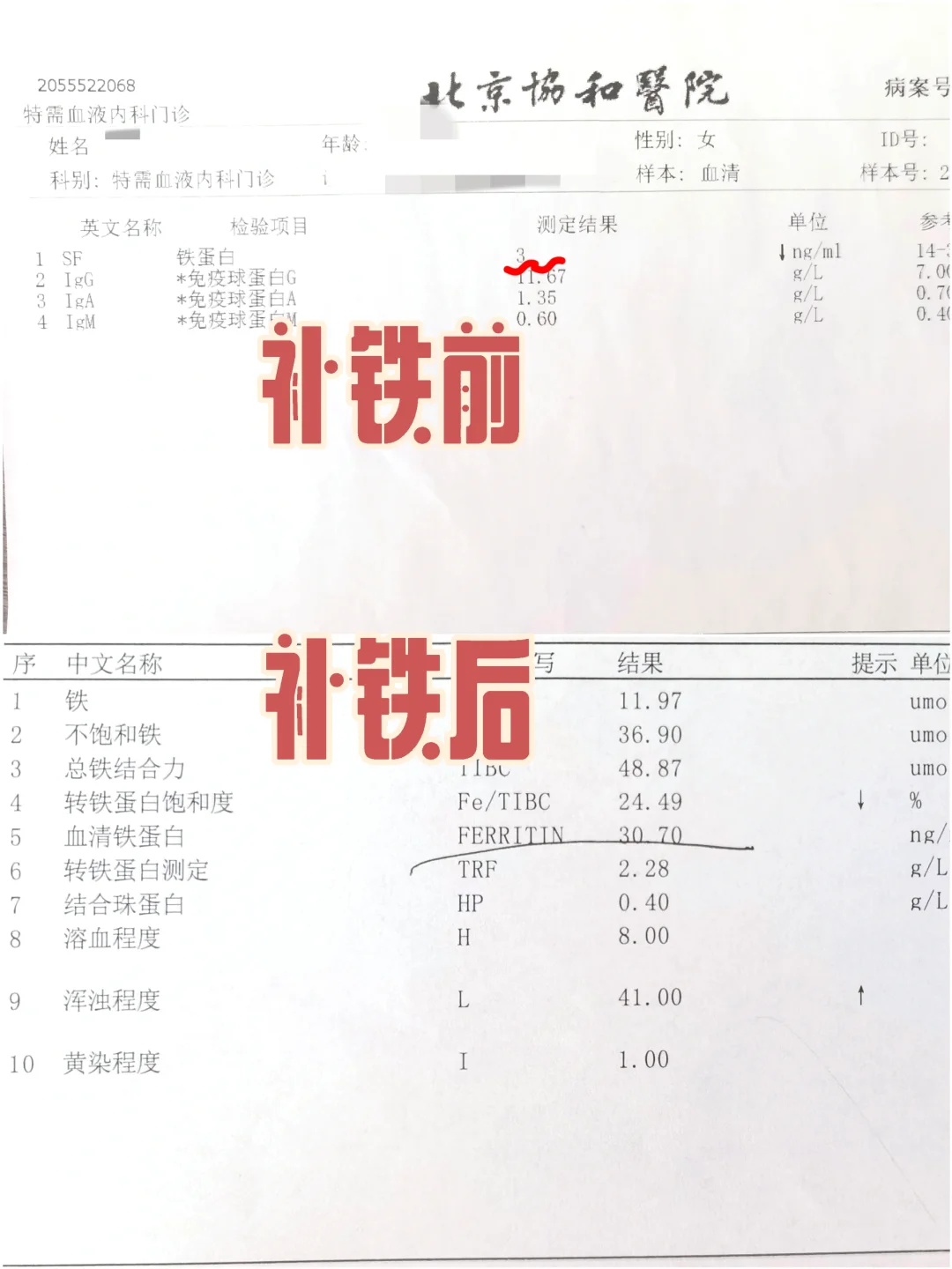 缺铁性贫血，喝铁剂不管用的