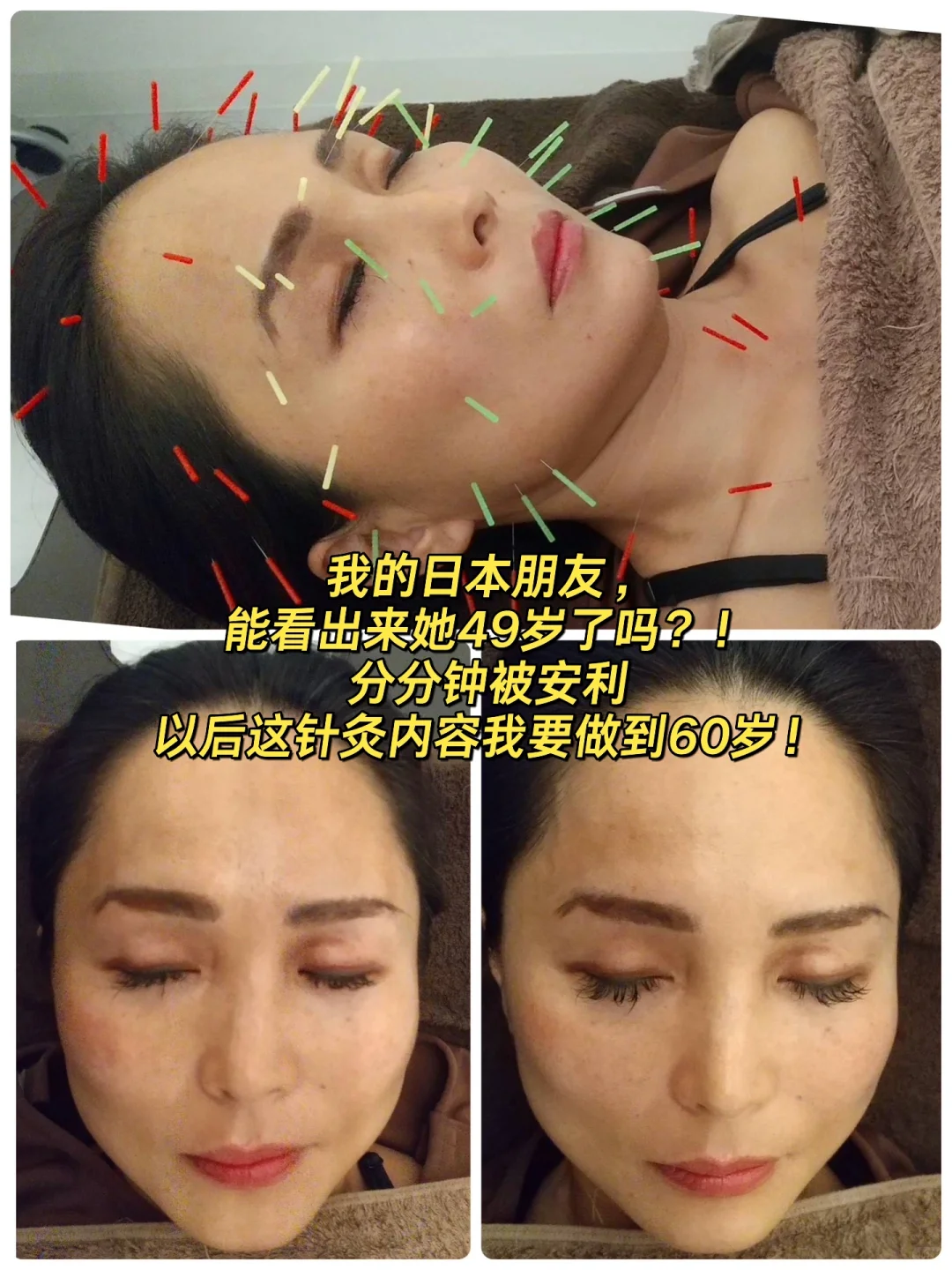 🇯🇵美容针灸 | 1次就能看到脸UP了，厉害