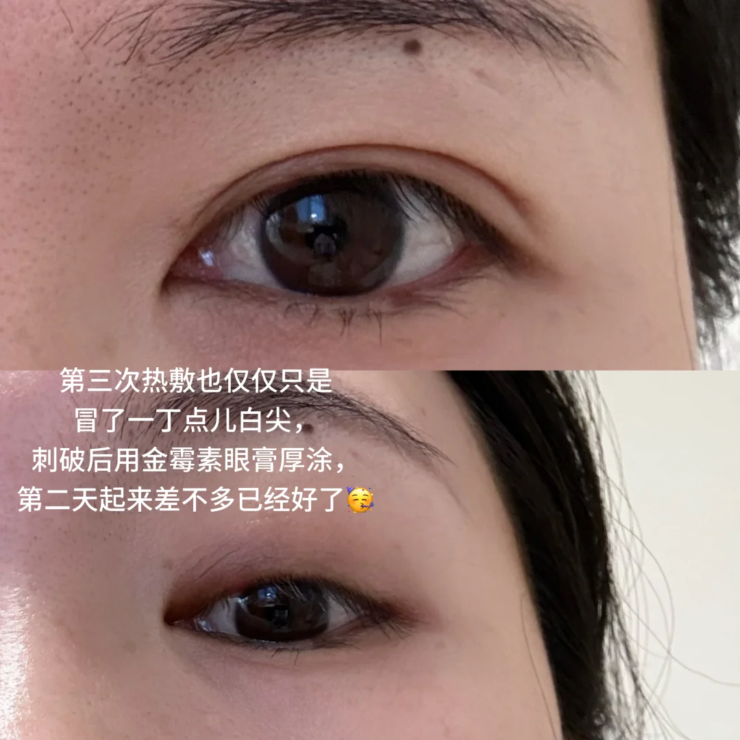 热敷可以消除霰粒肿❗️