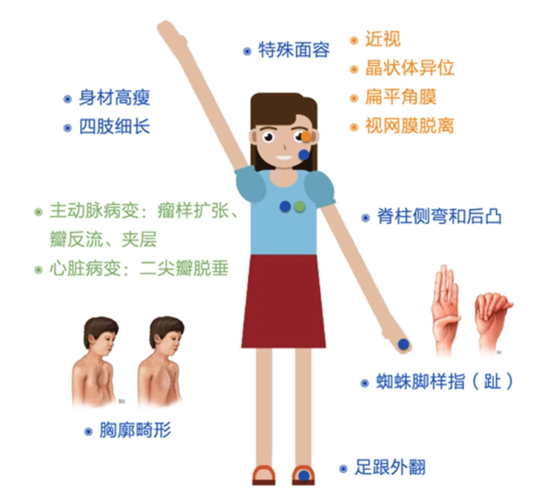 马凡综合征有哪些特征？