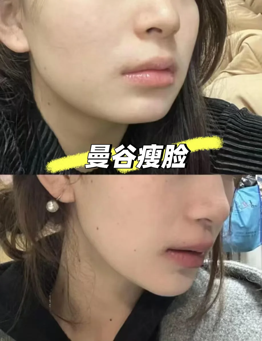 泰国🇹🇭曼谷|当方圆脸biu瘦脸➕下巴后