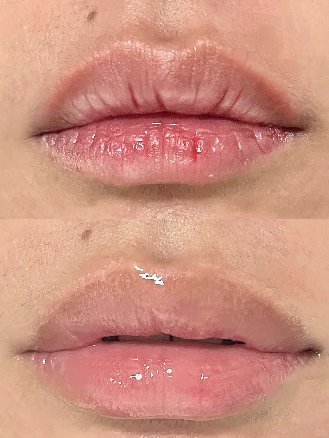 生理盐水敷唇炎,真的有点东西!