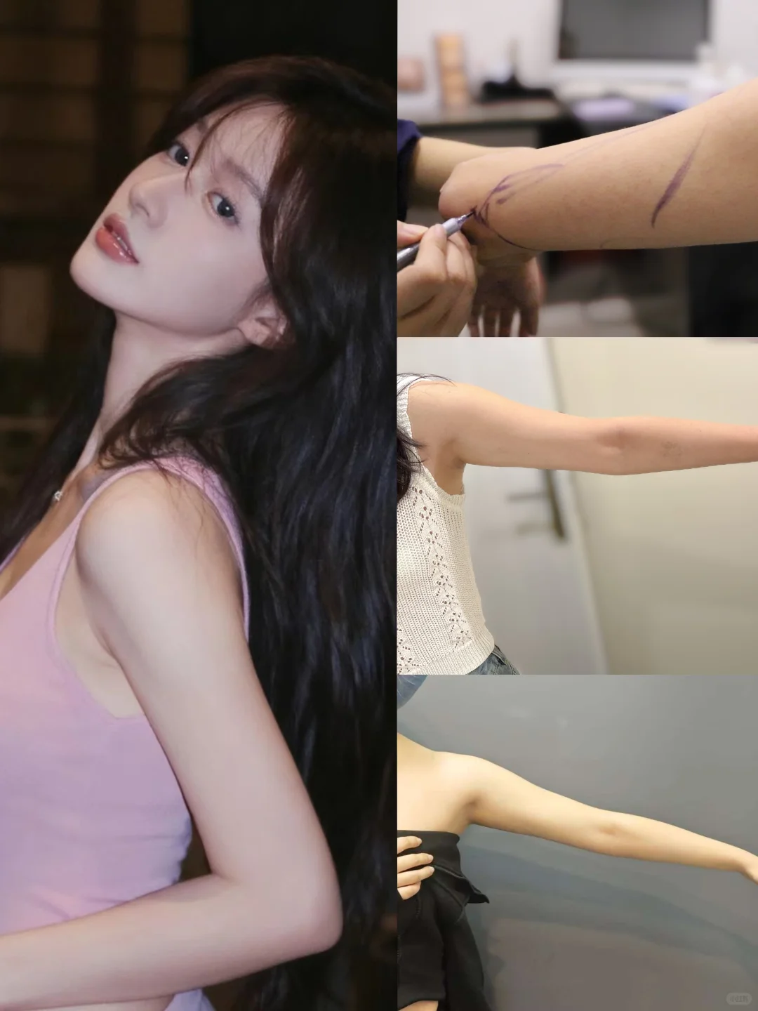 手臂粗救星!做低创吸脂,穿衣自由轻松 get