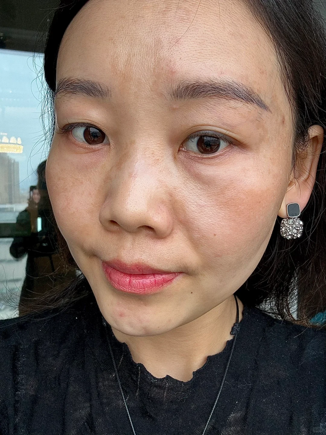 38岁生完娃,爆发出来的黄褐斑