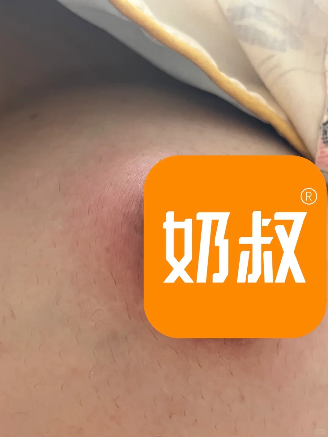 乳腺炎