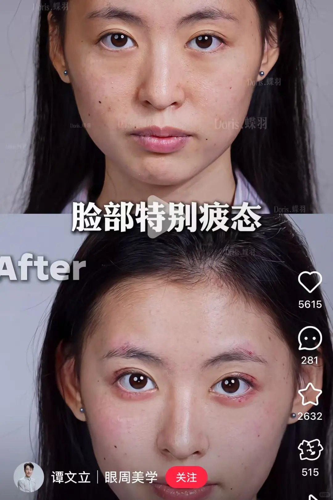 谭文立眶周年轻化真的好顶!