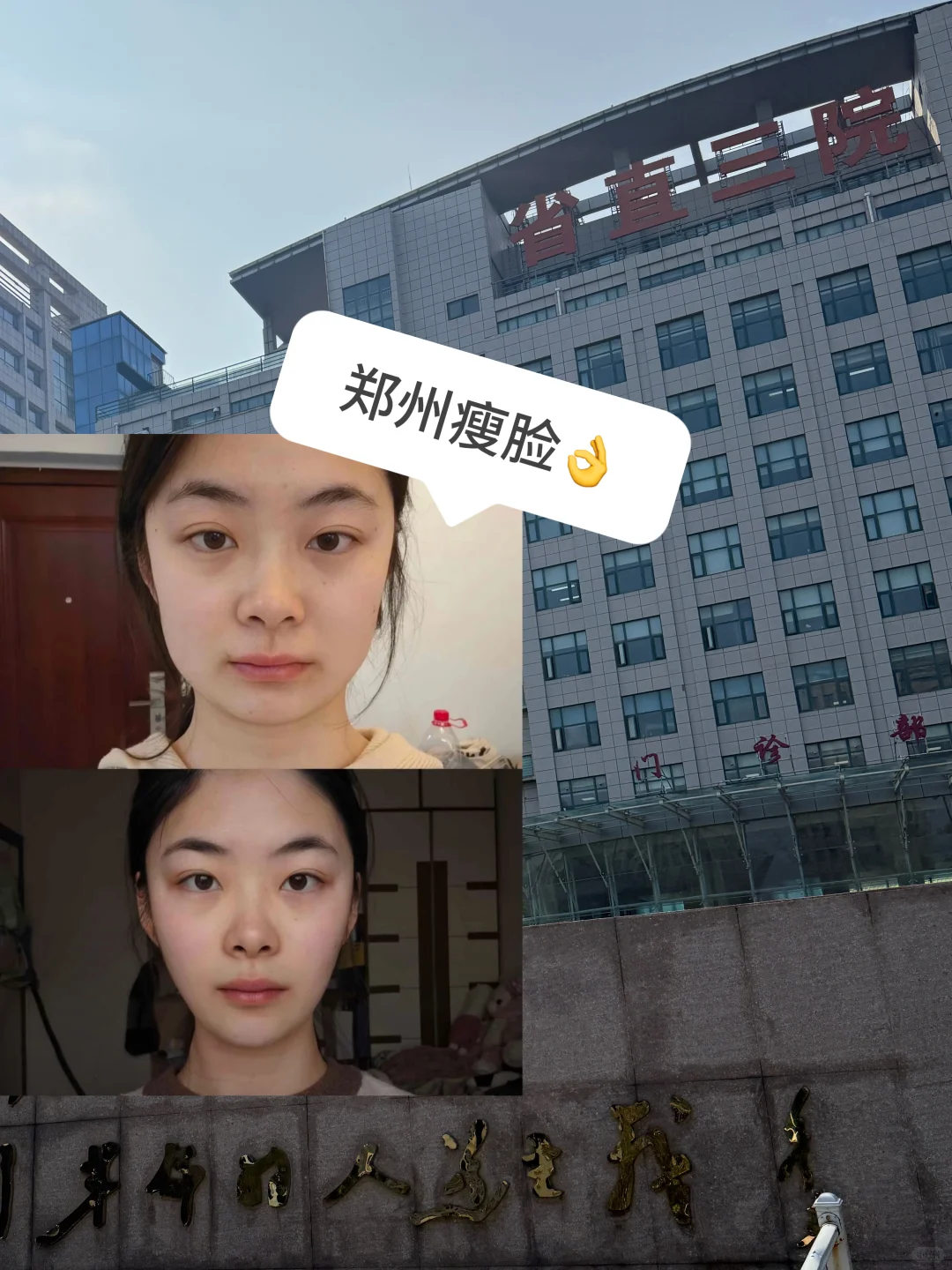 郑州瘦脸2.8k瘦脸Day60