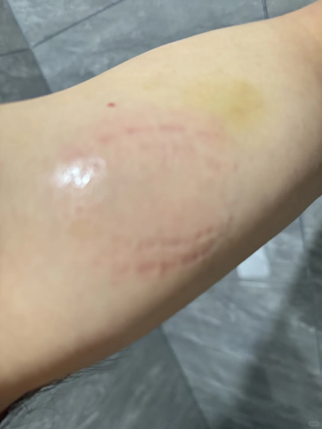 一个人异地痔疮手术流水账记录