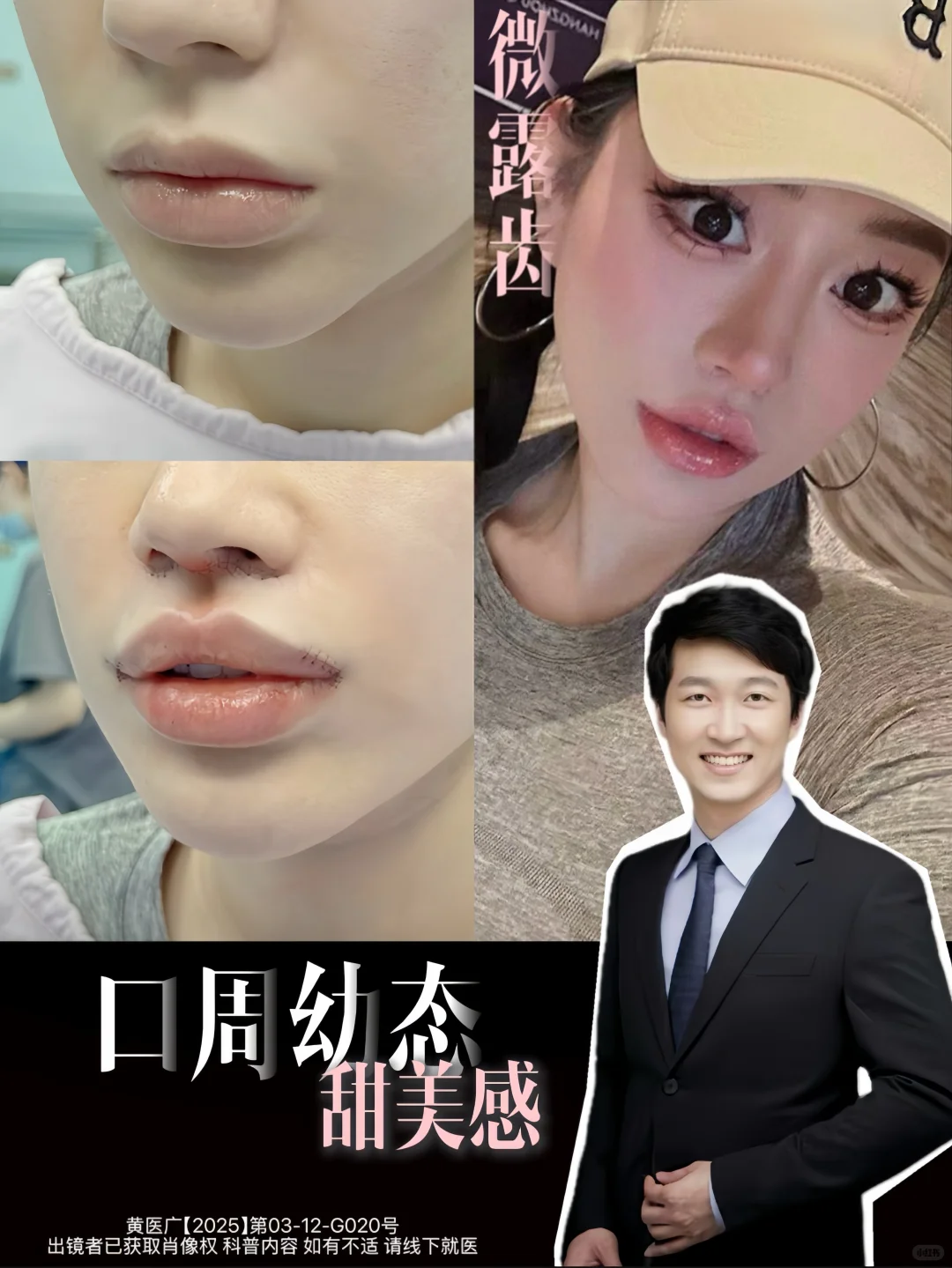 口周幼态+甜美感，get✅变美思路！