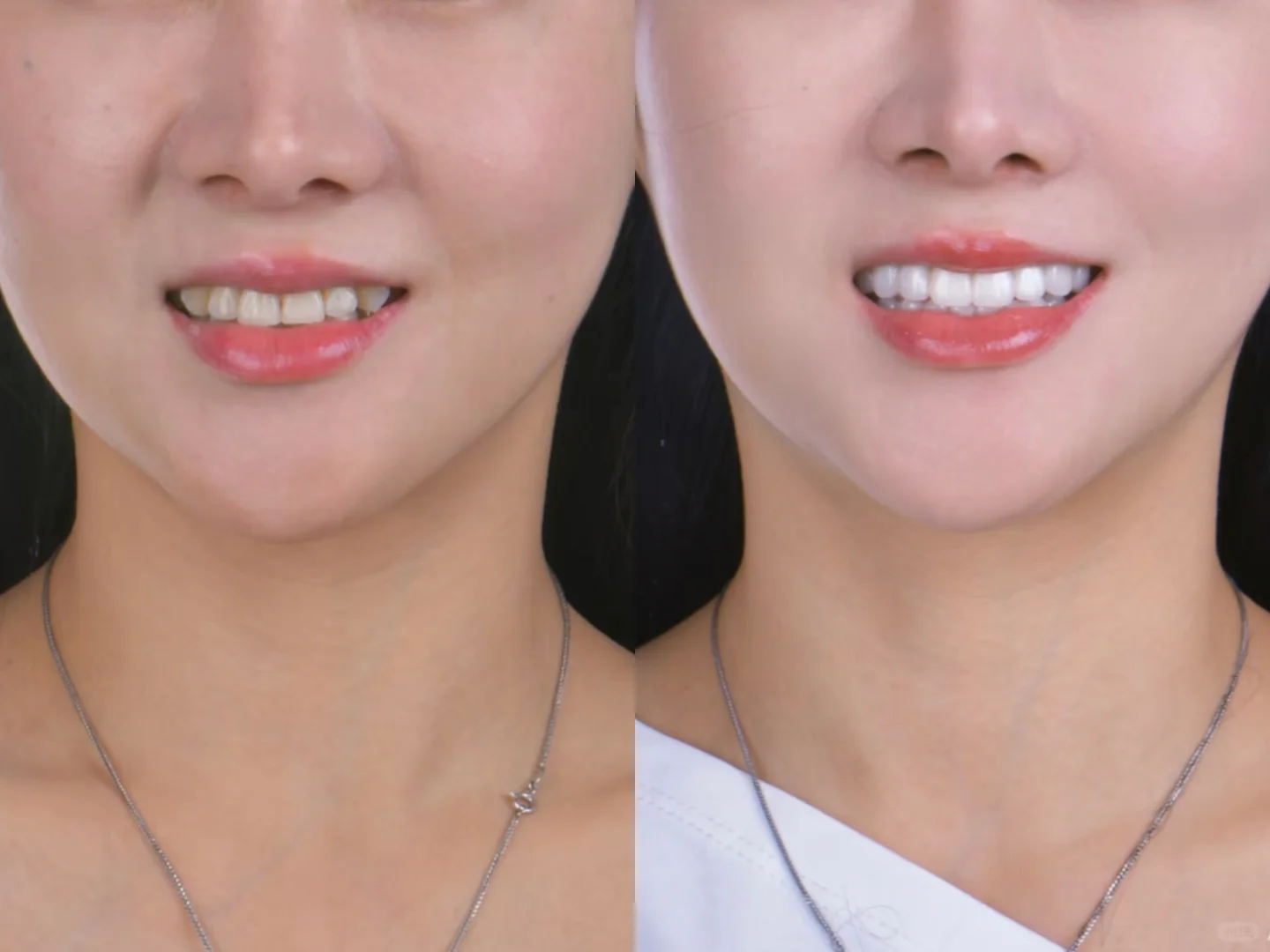 黄牙被轻松拿捏｜女大学生勇敢尝试牙贴面