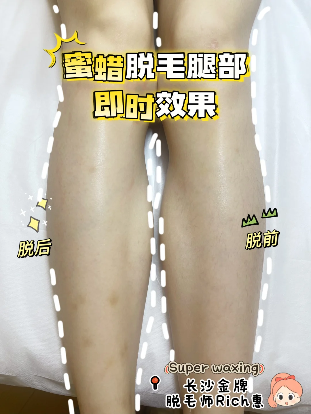 女士蜜蜡脱毛｜来一场光滑的邂逅