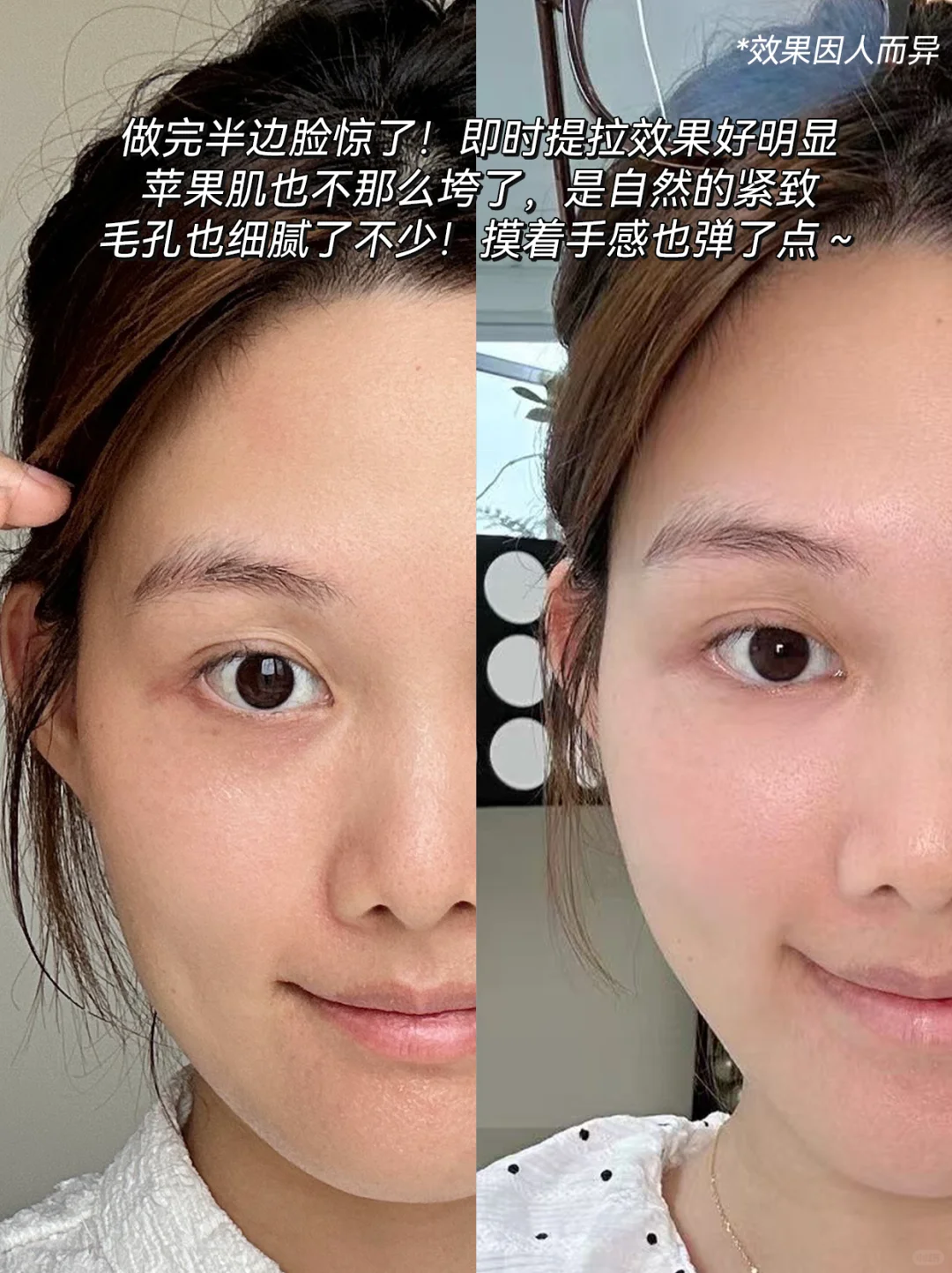 械Ⅲ医用美容仪到货反馈：提拉紧致有用吗？