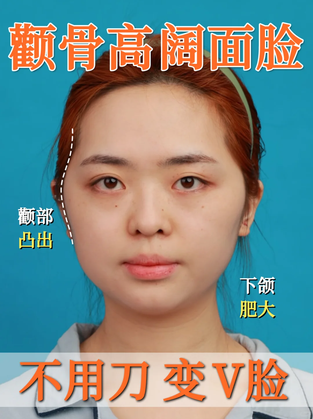 颧骨高阔面脸、下颌线不明显｜改善指南