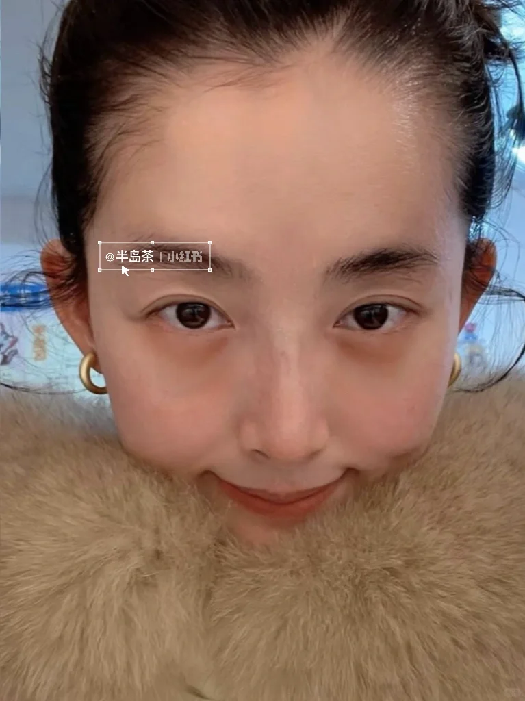 33岁一针打飞眼尾，朋友问我到底经历了什么～