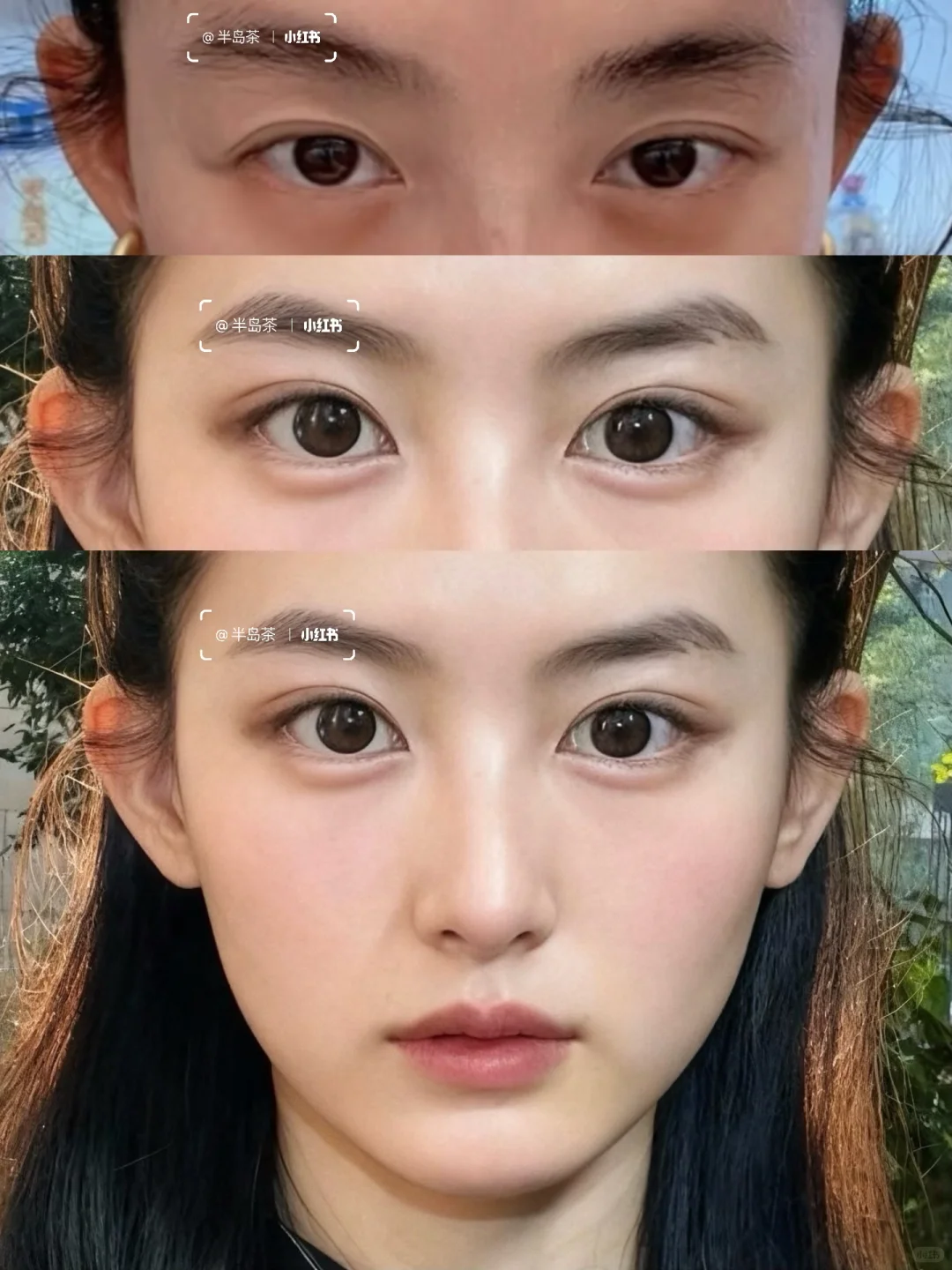 33岁一针打飞眼尾，朋友问我到底经历了什么～