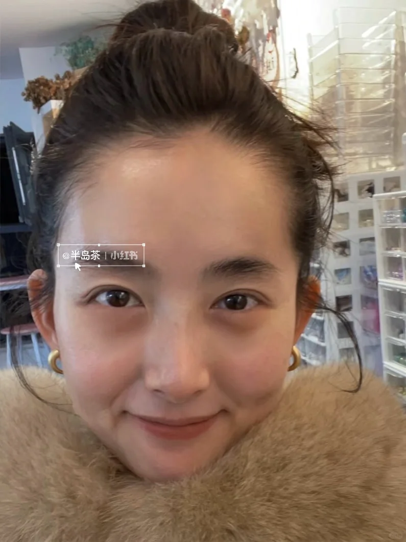 33岁一针打飞眼尾，朋友问我到底经历了什么～